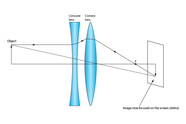 Concave lens used in conjunction with a convex lens to focus an image